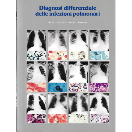 Diagnosi differenziale delle infezioni polmonari