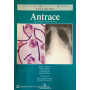 Antrace
